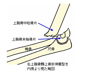 上腕骨顆上骨折伸展型説明図３