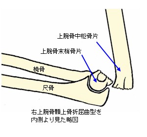 上腕骨顆上骨折屈曲型説明図２