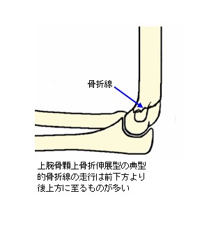 上腕骨顆上骨折伸展型説明図２