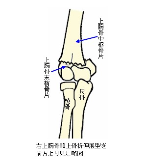 上腕骨顆上骨折伸展型説明図４
