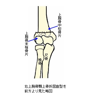 上腕骨顆上骨折屈曲型説明図３