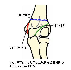 上腕骨遠位端骨折の骨折線説明図１
