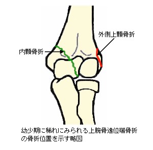 上腕骨遠位端骨折の骨折線説明図２