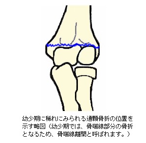 上腕骨遠位端骨折の骨折線説明図３