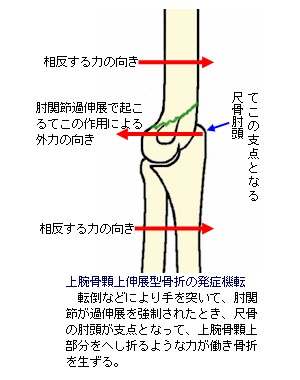 上腕骨顆上骨折伸展型説明図１