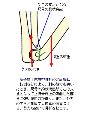 上腕骨顆上骨折屈曲型説明図１