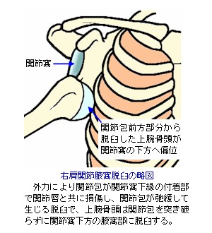 肩関節腋窩脱臼の略図
