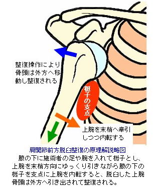 肩関節前方脱臼整復の原理解説略図