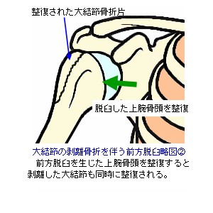 大結節剥離骨折と前方脱臼の整復後の略図