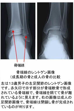 足関節の骨端線