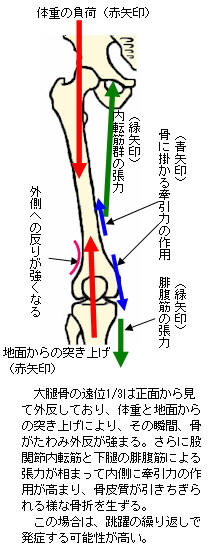 大腿骨骨幹部疲労骨折の発生力学3
