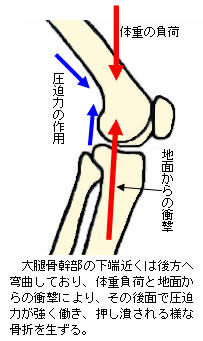 大腿骨骨幹部疲労骨折の発生力学4