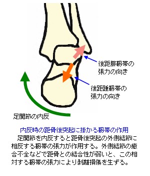 足関節内反による距骨後突起の靭帯作用