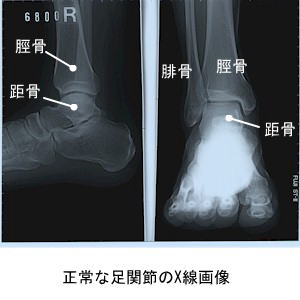 正常な足関節のX線画像