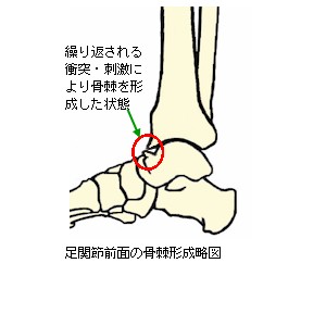 足関節前面の骨棘略図