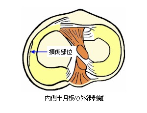 膝半月板の外縁剥離