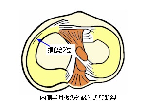 膝半月板の外縁付近縦断裂