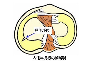 膝半月板の横断裂