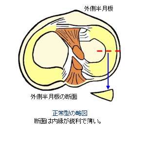 膝半月板の形状〜正常型