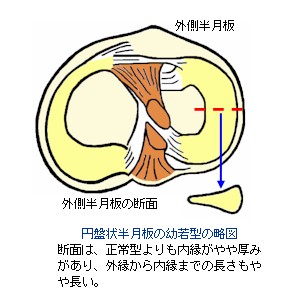 膝半月板の形状〜幼若型