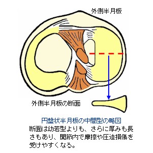 膝半月板の形状〜円盤状半月板の中間型