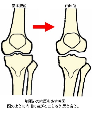 膝関節の内反を表す略図