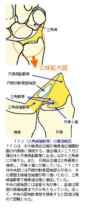 TFCの構造略図