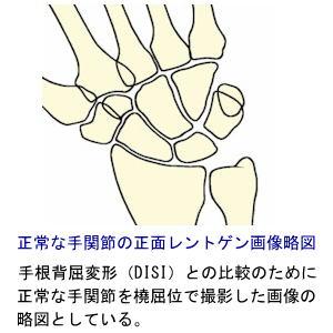 正常な手関節の正面Ｘ線画像略図