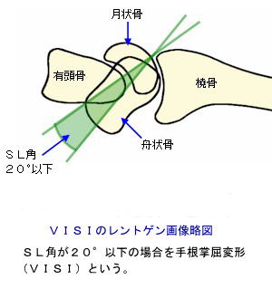 VISIのレントゲン画像略図
