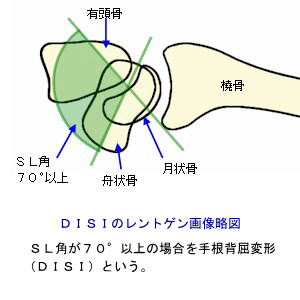 DISIのレントゲン画像略図２