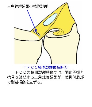 TFCC橈側裂離損傷