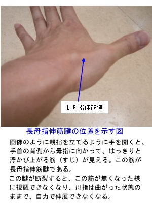 長母指伸筋腱の位置を示す図