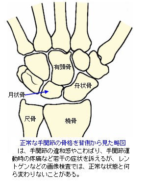 正常ｊな手関節の骨格を背側から見た略図