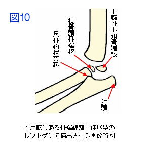 上腕骨通顆骨端線離開伸展型骨片転位X線略図