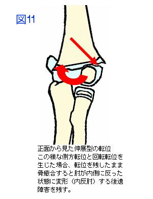 上腕骨通顆骨端線離開伸展型の転位正面略図